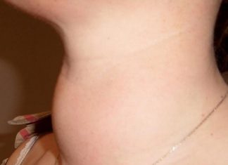 Cách phát hiện sớm và phòng tránh bệnh U bướu nhân giáp