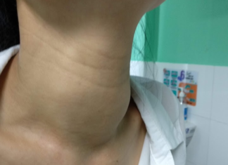 Tạm biệt bướu giáp nhân không phẫu thuật