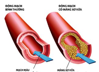 Rối loạn mỡ máu là gì ?