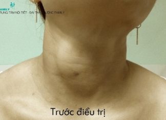 Hiệu quả sau đốt sóng cao tần bướu giáp nhân lành tính