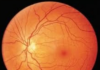 Bệnh võng mạc đái tháo đường