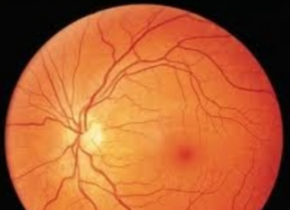 Bệnh võng mạc đái tháo đường
