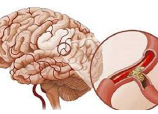 Xơ vữa động mạch có nguy hiểm hay không ?
