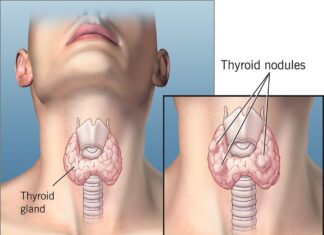 Có mối liên quan giữa kích thước nhân giáp và nguy cơ ác tính hay không?