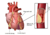 Làm thế nào để phát hiện bệnh động mạch vành