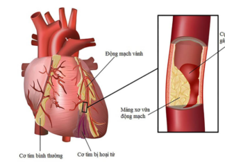 Làm thế nào để phát hiện bệnh động mạch vành