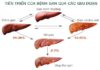 Gan nhiễm mỡ có  thực sự nguy hiểm??