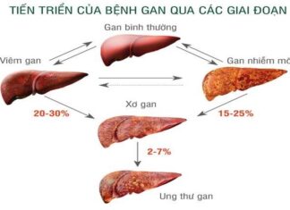 Gan nhiễm mỡ có thực sự nguy hiểm??