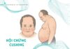 Hội chứng Cushing