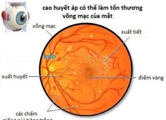 Bệnh tăng huyết áp ảnh hưởng đến mắt như thế nào?
