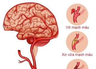 Dấu hiệu nhận biết đột quỵ