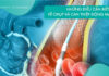 Những điều cần biết về chụp và can thiệp động mạch vành