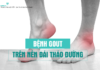 Bệnh gout/ tăng aicd uric trên bệnh nhân đái tháo đường