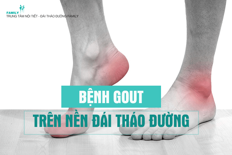 Mối liên hệ giữa tăng huyết áp và gút là gì?
